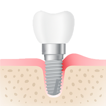 Esquema de preservación ósea en implantes