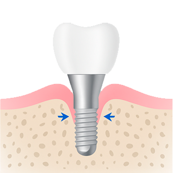 Esquema de sellado bacteriano en implantes